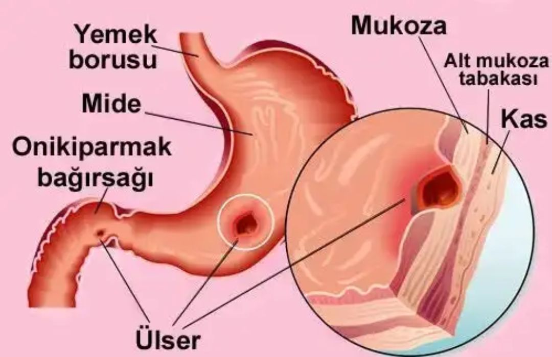 Sintomas de ulcera anal