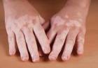 Vitiligo Nedir?  Vitiligo Belirtileri Nelerdir? Vitiligo Nasıl Geçer?