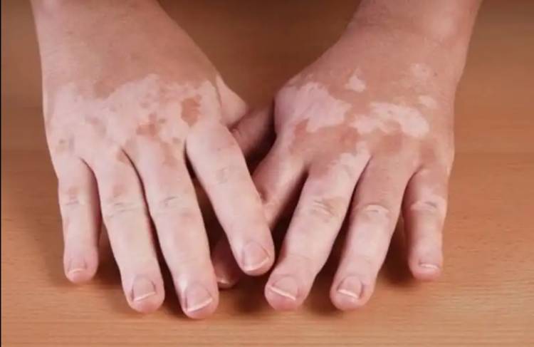Vitiligo Nedir?  Vitiligo Belirtileri Nelerdir? Vitiligo Nasıl Geçer?